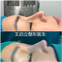 河南隆鼻整形医生
