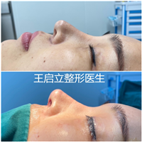 河南鼻整形医生