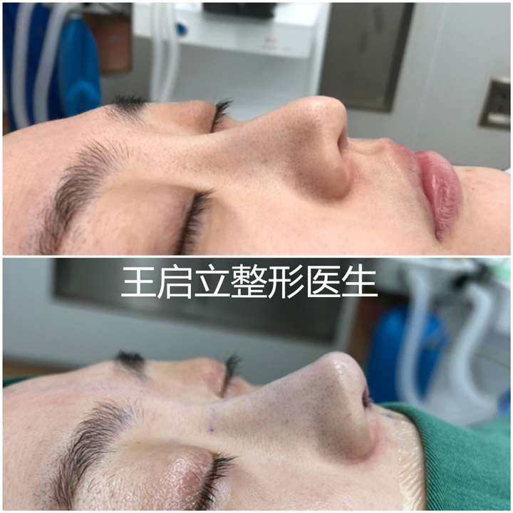 王启立做鼻子怎么样