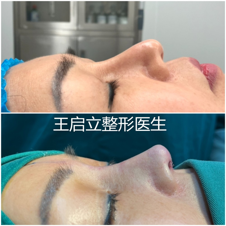河南隆鼻整形医生