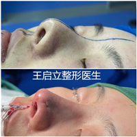 王启立医生分享隆鼻材料到底该选肋软骨还是耳软骨？