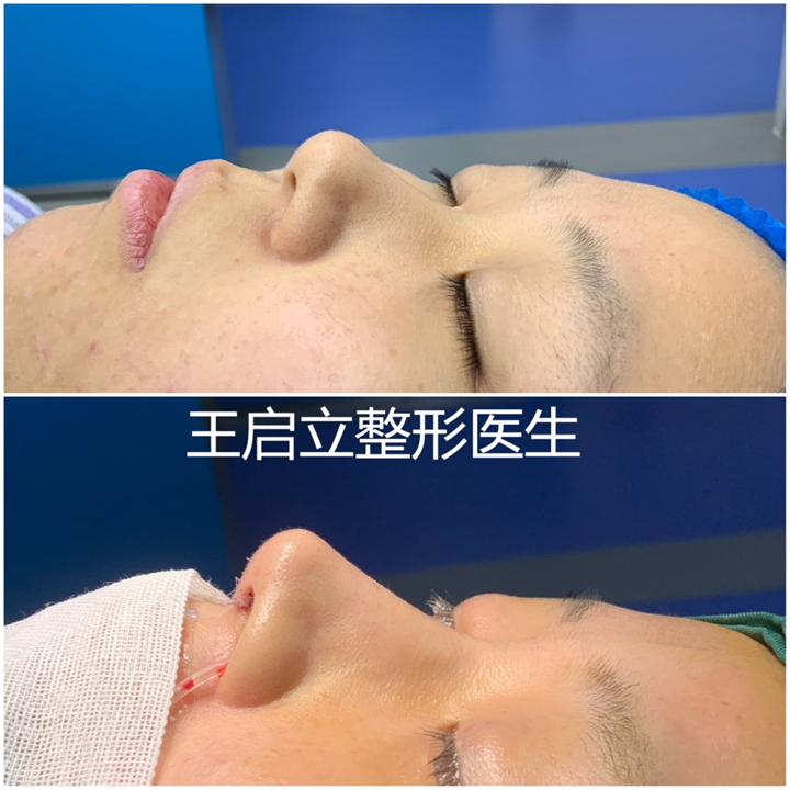鼻基底对颜值有多大影响？