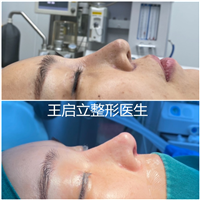 河南鼻整形医生