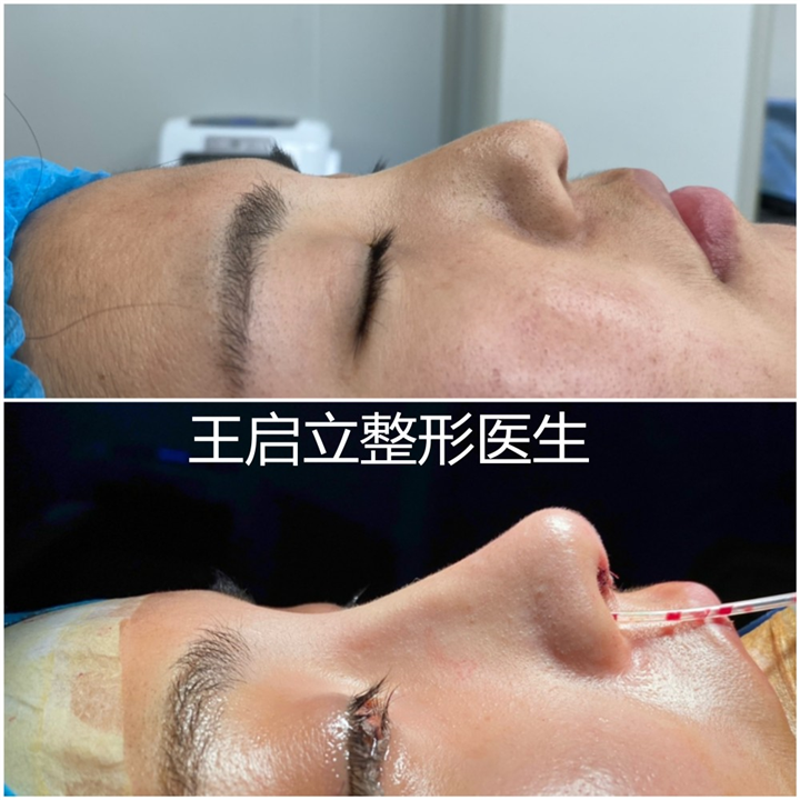 王启立鼻整形