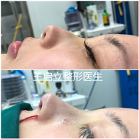 河南隆鼻整形医生