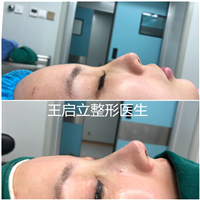 河南隆鼻整形医生
