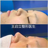 鼻基底对颜值有多大影响？