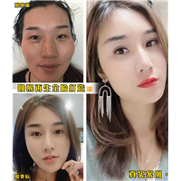 北京剥离唤醒再生术