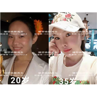 剥离再生术
