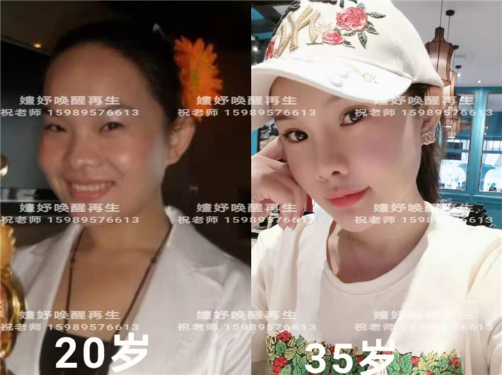 剥离再生术