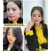 内蒙古剥离微整