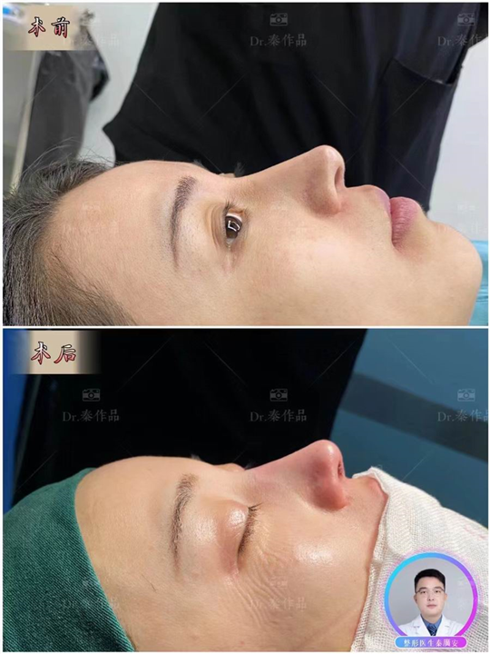 深圳鼻整形医生