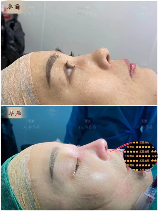 深圳鼻综合整形专家