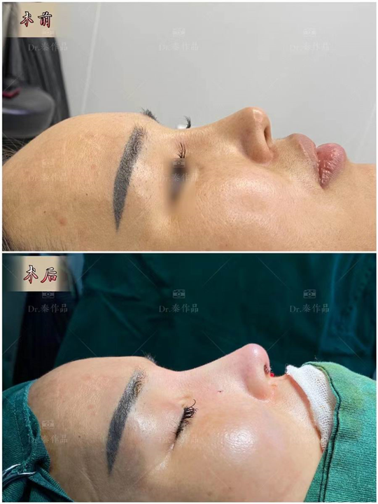 深圳鼻整形医生