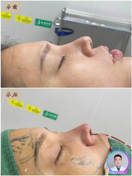 深圳鼻整形医生