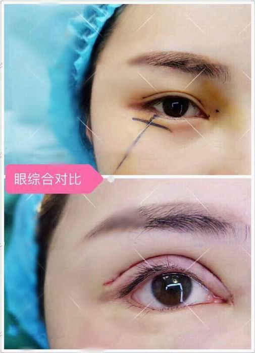 上海埋线双眼皮价格是多少
