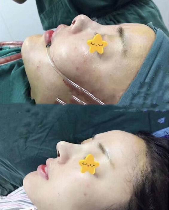 上海童颜整形|上海芭比童颜整形