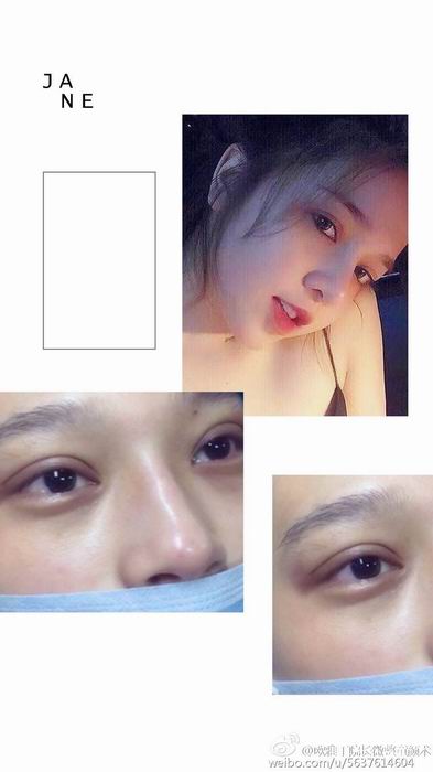 上海埋线双眼皮价钱|上海做双眼皮多少钱