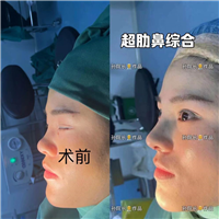 郑州肋骨鼻整形专家