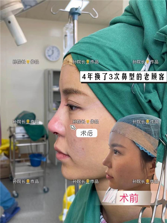 郑州整形孙玮都无需引流微创技术