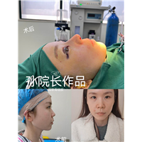 孙玮都医生鼻整形案例