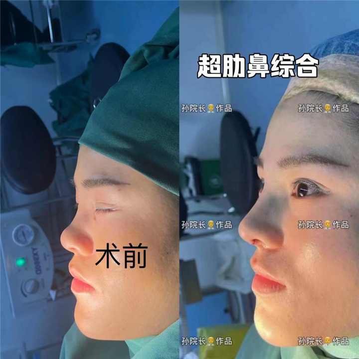郑州肋骨鼻整形专家
