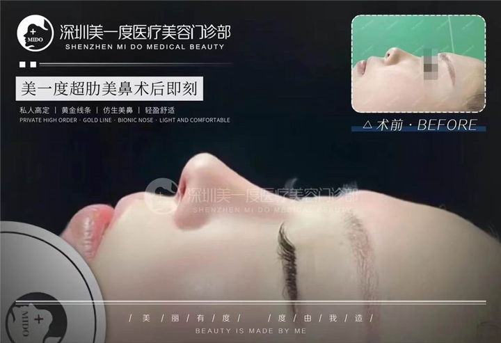 深圳超肋鼻综合整形