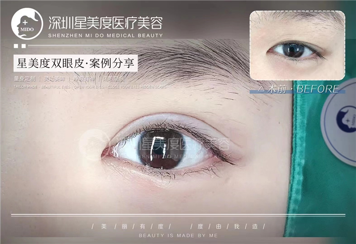 深圳高级脸打造