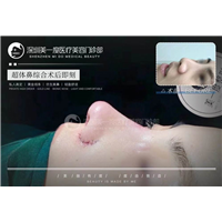深圳超肋鼻综合整形