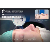 深圳超肋鼻综合整形