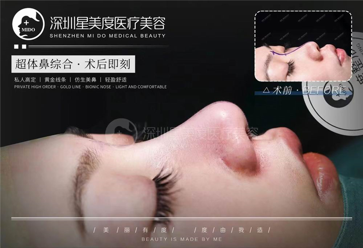 深圳超肋鼻综合整形