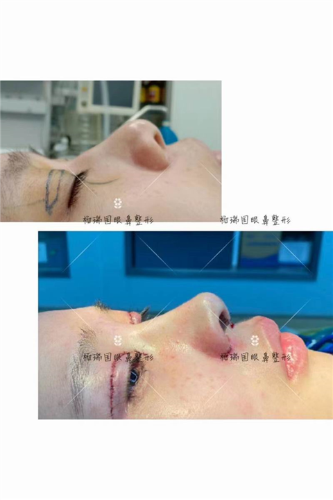 杨瑞国高难度鼻整形