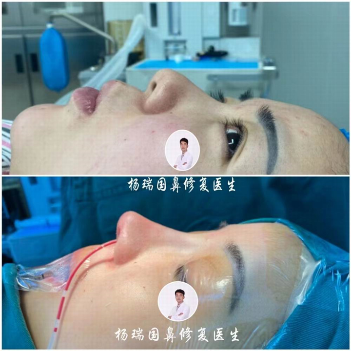 郑州鼻整形修复