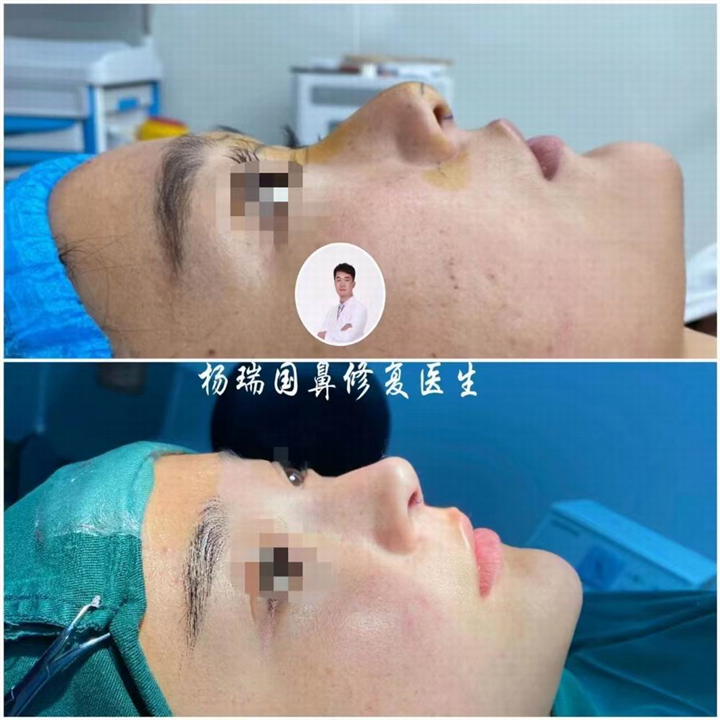 郑州鼻整形专家