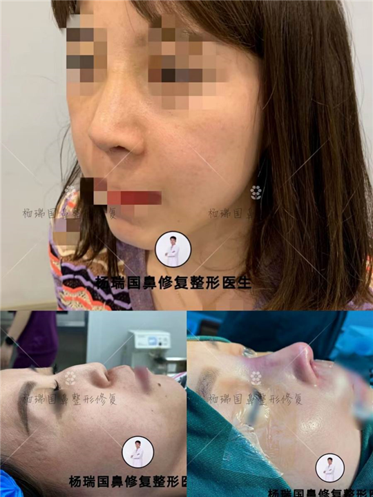 杨瑞国高难度鼻整形
