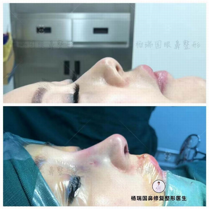 杨瑞国高难度鼻整形