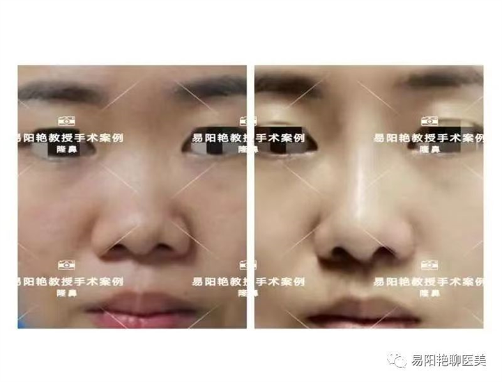 易阳艳医生做鼻子怎么样