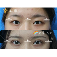南昌易阳艳割双眼皮怎么样