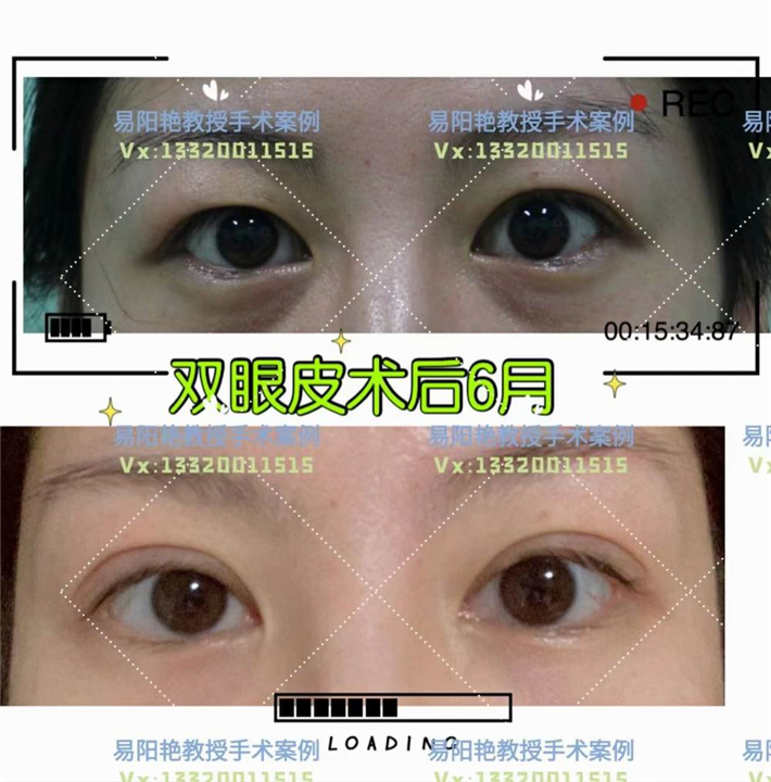 易阳艳双眼皮手术案例