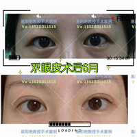 易阳艳双眼皮手术案例