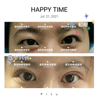 南昌易阳艳割双眼皮