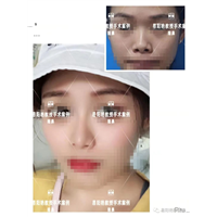 易阳艳医生自然鼻子打造
