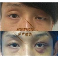 南昌易阳艳割双眼皮怎么样