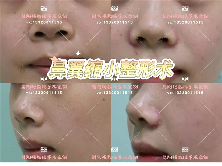 易阳艳鼻综合整形
