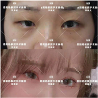 南昌易阳艳割双眼皮