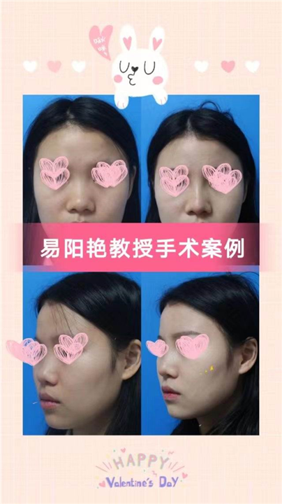 南昌易阳艳医生做鼻子怎么样
