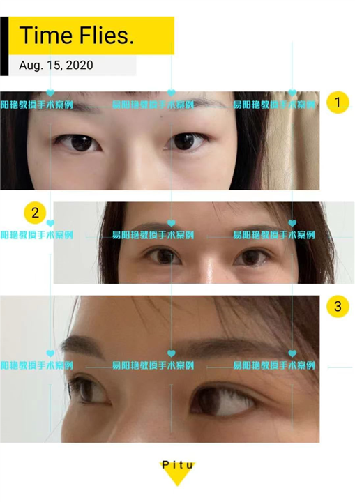 南昌做双眼皮哪家好