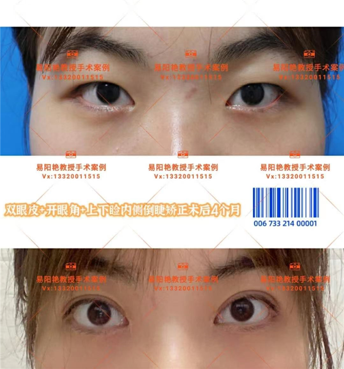 易阳艳双眼皮手术案例