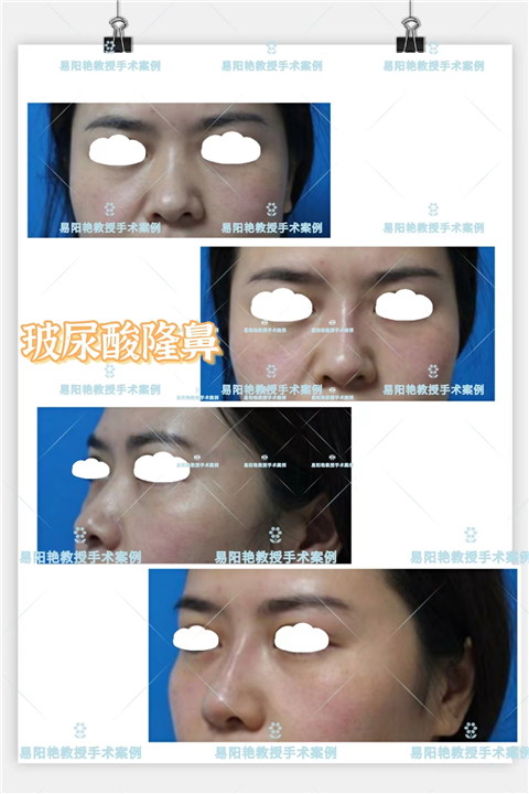 易阳艳鼻综合整形