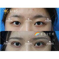 易阳艳双眼皮手术案例